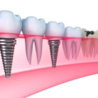 Dental-Implant22