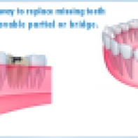 dental-implants 2